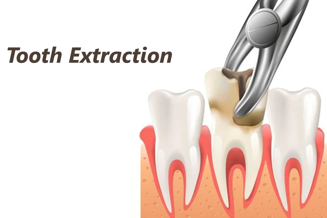 Tooth Extraction