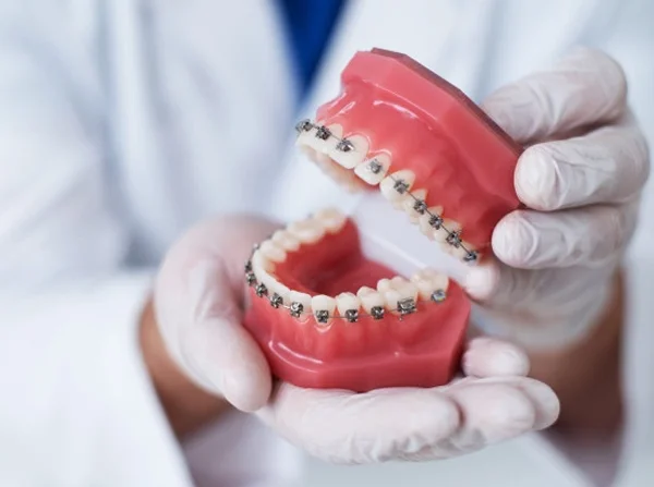 Braces Treatment