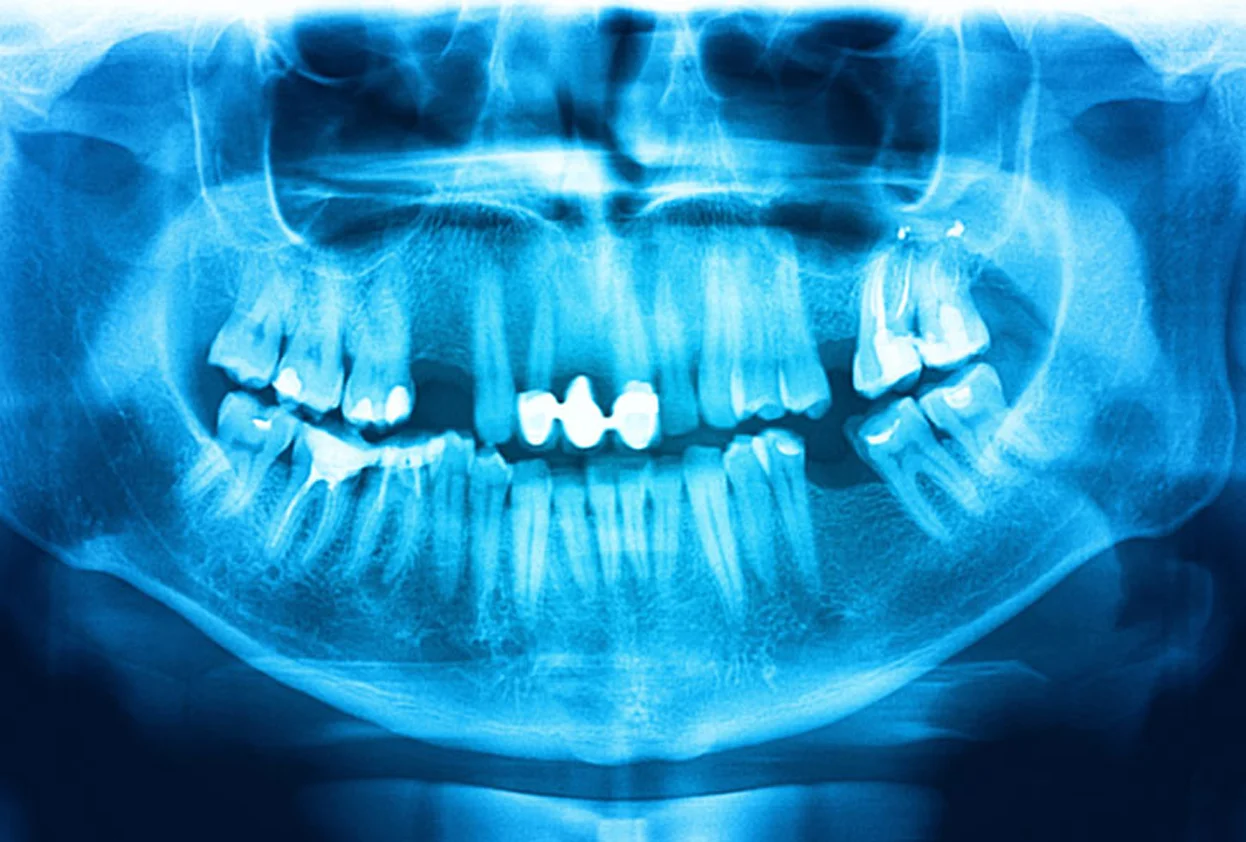 Teeth X-ray