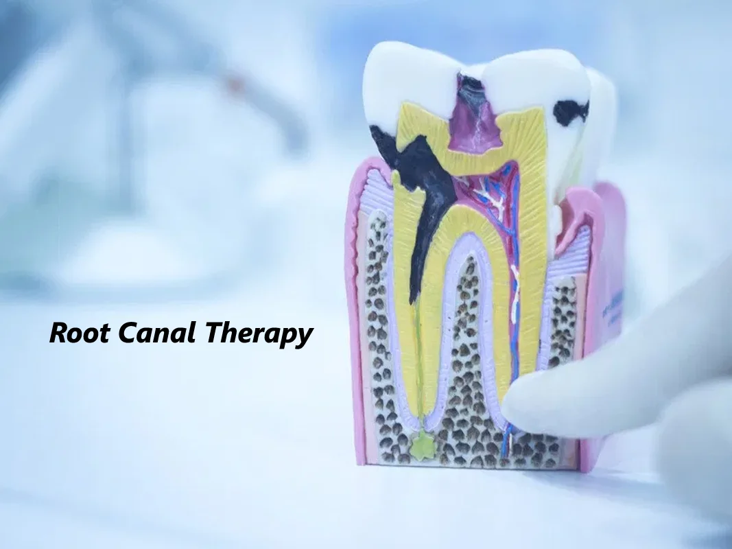 Root Canal Treatment