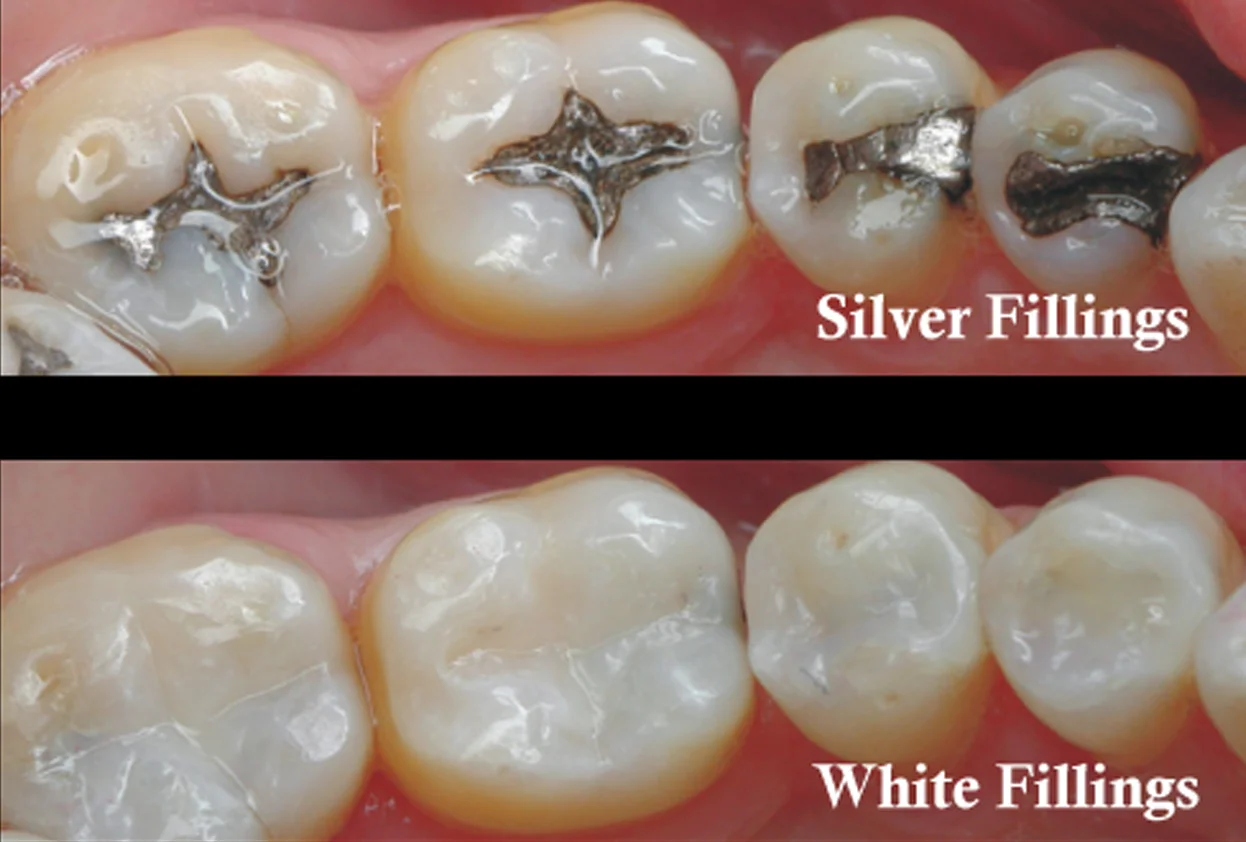 Teeth Color Crown