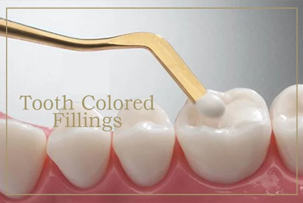 Tooth Colored Filling